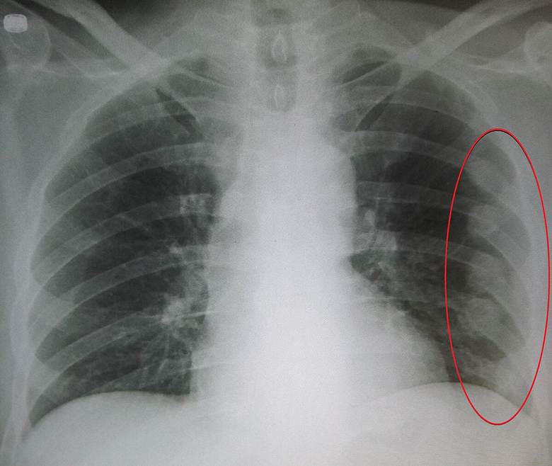 RIB FRACTURE